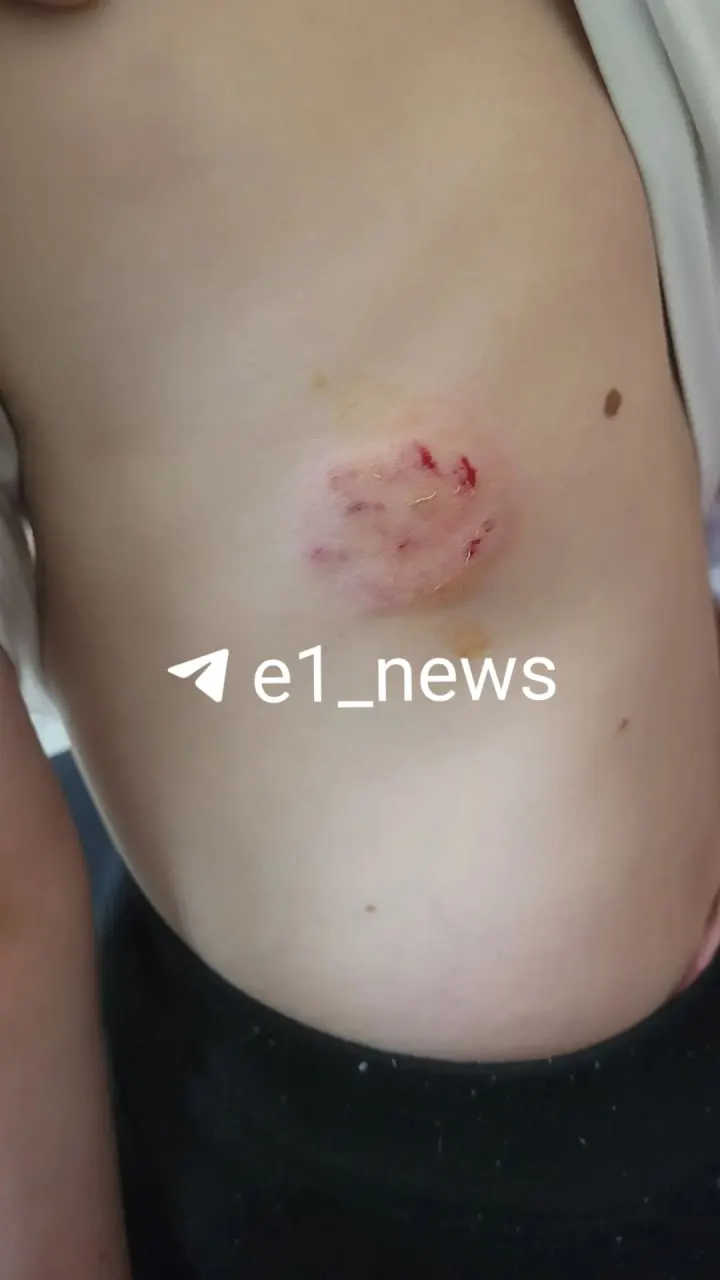 В Октябрьском районе собака вырвалась с поводка и укусила ребёнка на игровой площадке. Семья обратилась в полицию и в больницу, просят владельца подтвердить сведения о прививках животного.