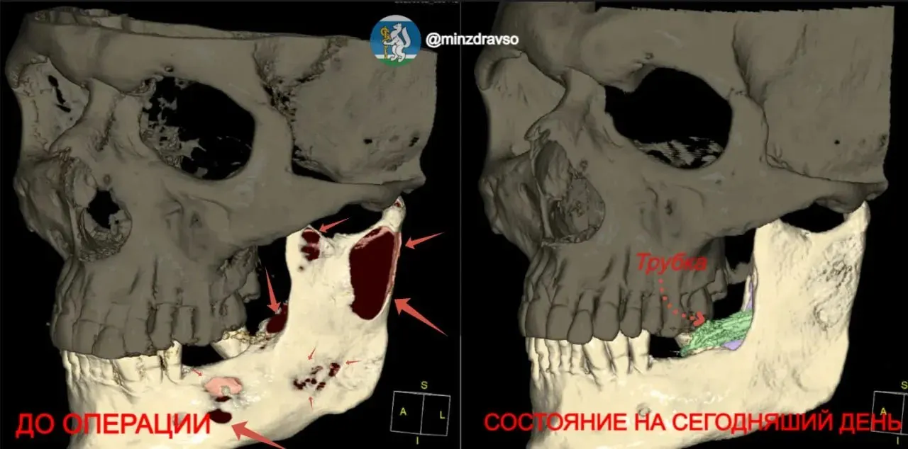 У пациента обнаружили гигантскую кисту, разросшуюся от коренных зубов до височно‑нижнечелюстного сустава. Врачи удалили зуб мудрости и установили дренаж без разрезов на лице; на полное восстановление потребуется около двух лет.